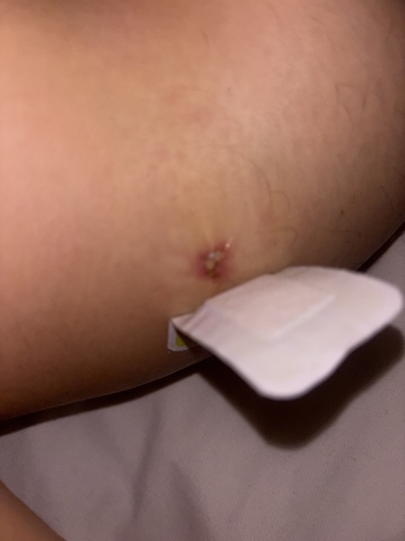 Does this look infected ? Any nurses about