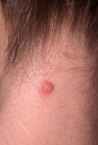 Concerning mole need reassurance, Pic included