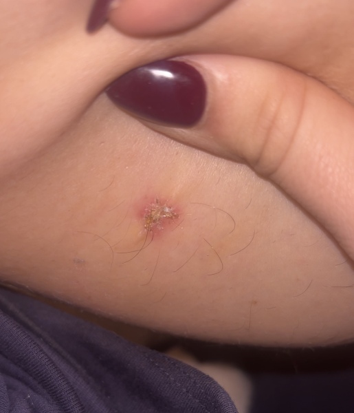 Does this look infected ? Any nurses about