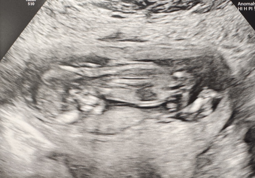 Recurrent Chemical Pregnancies