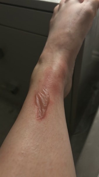 How does this burn look?