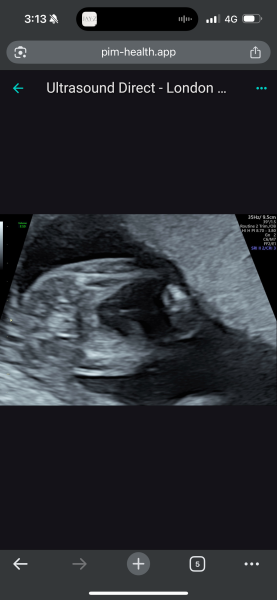 17wk scan - coming to terms with gender