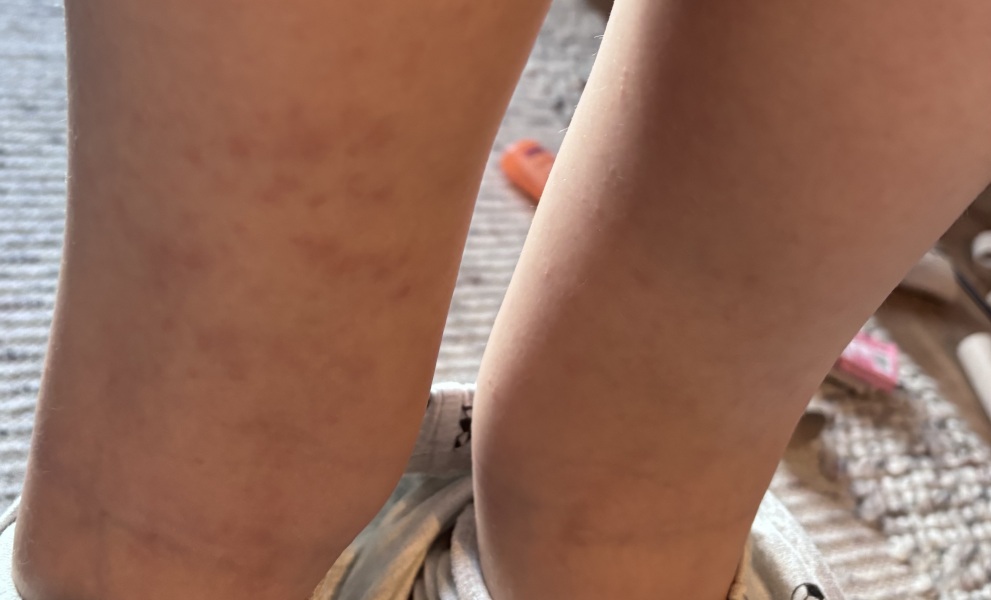 Is this chicken pox?