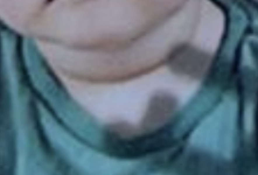 Does this look like a potential sign of hyperthyroidism in 18mo?