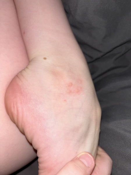 Spots/rash on son