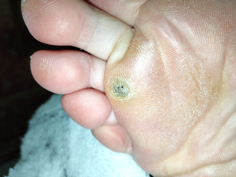How do I get rid of this verucca - warning, picture included