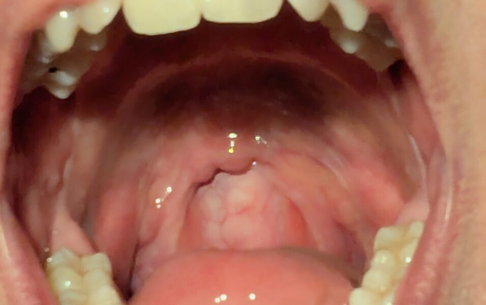 What is this on my throat?