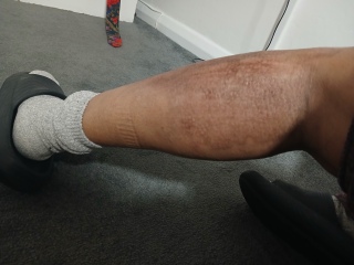 2nd degree burns from boiling water