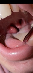 Tonsillitis or quinsy?