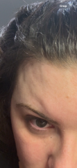 Forehead swelling