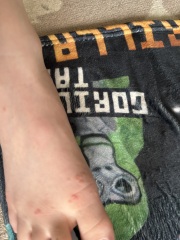 Spots/rash on son