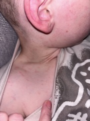 Is this chicken pox?