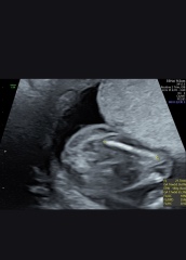 17wk scan - coming to terms with gender