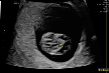 Fluid around fetus head and thickened NT at 10+2 week scan