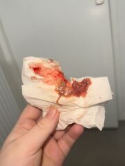 Did anyone have this discharge?