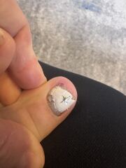Help my toenail is coming off