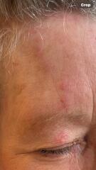 Shingles