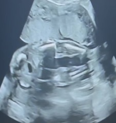 20 week potty shot. What’s your guess- girl or boy?