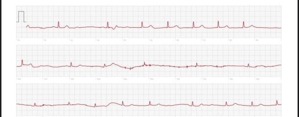 Pulse in 30s? How low is too low?