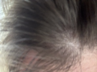 Hair loss and itchy scalp