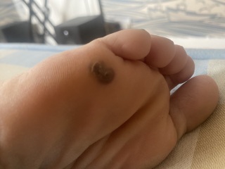 How do I get rid of this verucca - warning, picture included