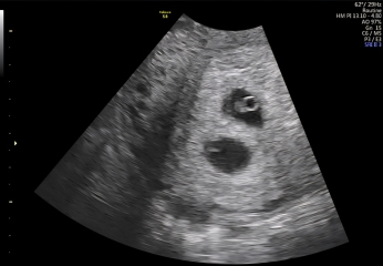 Anyone Doing FET/IVF Cycles in November 2025?