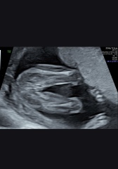 17week scan potty shot confirmation