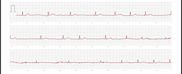 Pulse in 30s? How low is too low?