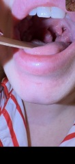 Tonsillitis or quinsy?