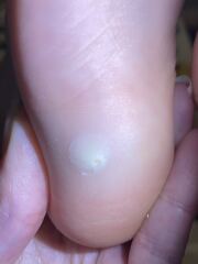 Does this look like a verruca? Or something else?