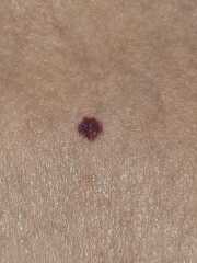 Is this a blood blister or.....