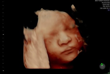 Gender guesses but only have 31 week 3D scan