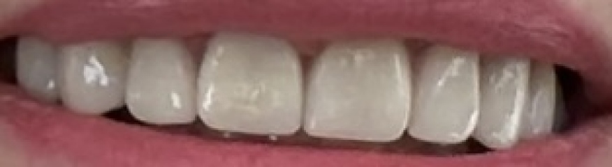 Not happy with new veneers