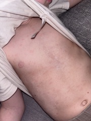 Is this chicken pox?