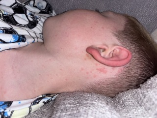 Is this chicken pox?