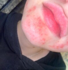 Treclin leaving skin so sore, what would calm it down?