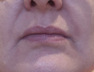 Melting face