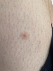 Mole on leg (pictures attached) 2WW referall, can anyone talk me down?