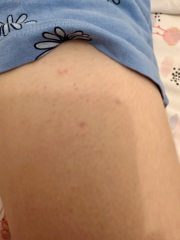 What is this rash on DD??