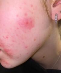 Treclin leaving skin so sore, what would calm it down?