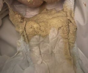 Poorly 4 month baby, pale poos!?