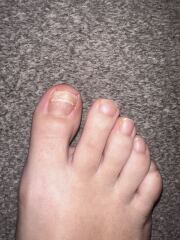 Don’t look if squeamish - need to have my toenail removed