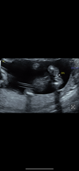 Does scan confirm baby girl?