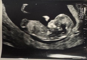 Gender guesses please! 12-week scan pics – nub/skull theory welcome