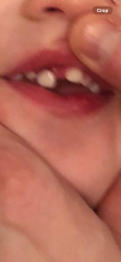 DS (21 months) has knocked tooth out of place. What will/can a dentist do? (Photo)