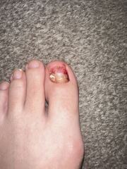 Don’t look if squeamish - need to have my toenail removed