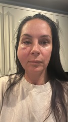 Endo lift complications