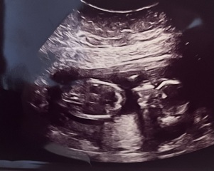 Gender guess- 15 weeks