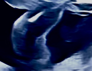 20 week potty shot. What’s your guess- girl or boy?
