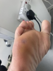 How do I get rid of this verucca - warning, picture included